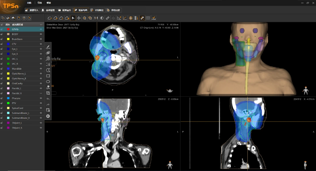 Treatment planning software showing dose distribution on axial, coronal and sagittal CT slices with a 3D view of contoured structures